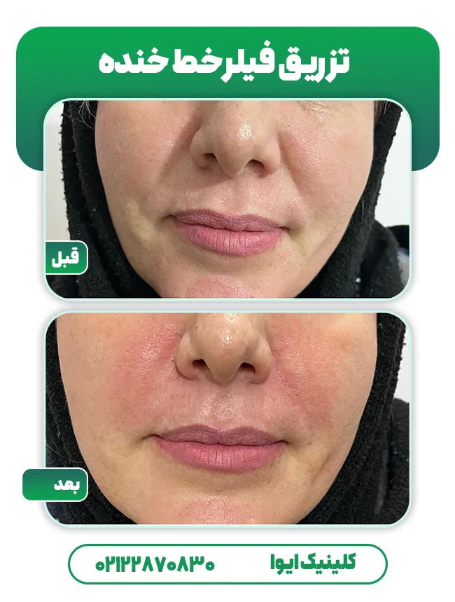 تزریق فیلر خط خنده