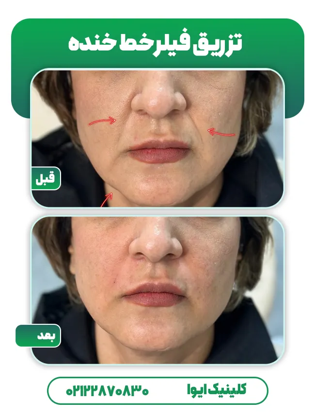 تزریق فیلر خط خنده