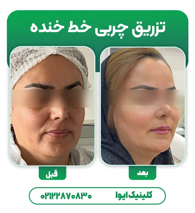 تزریق چربی خط خنده