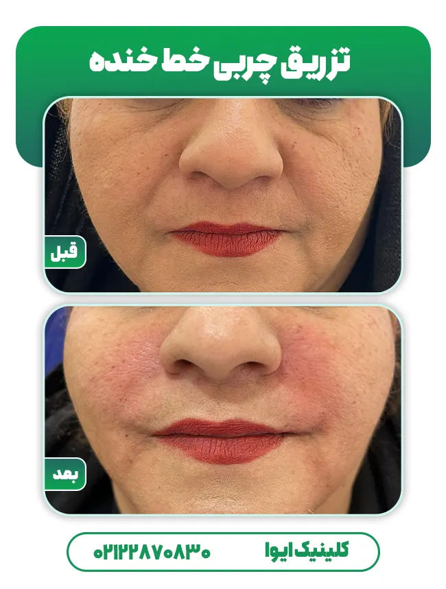 تزریق چربی به خط خنده