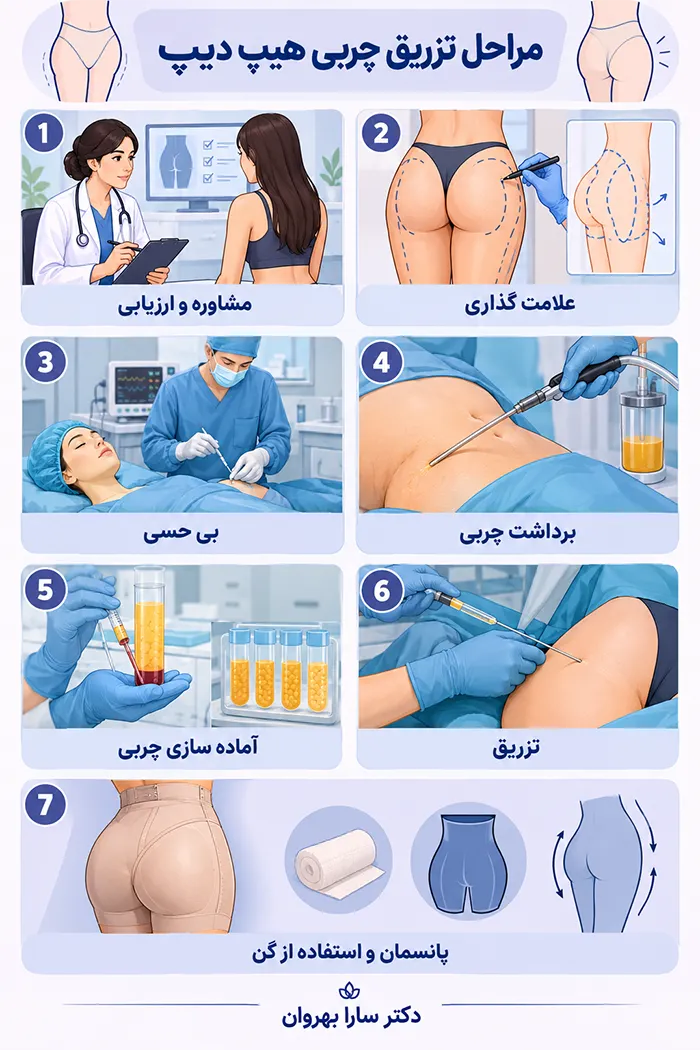 مراحل تزریق چربی هیپ دیپ