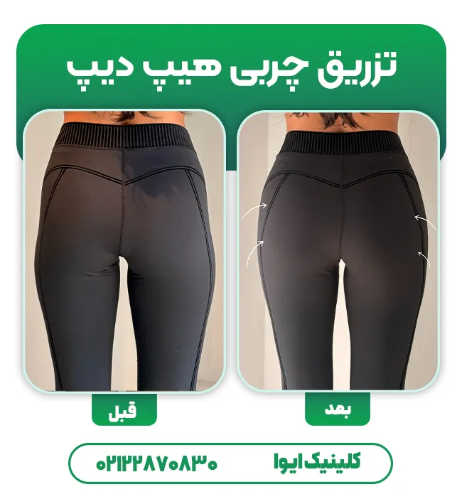 تزریق چربی هیپ دیپ