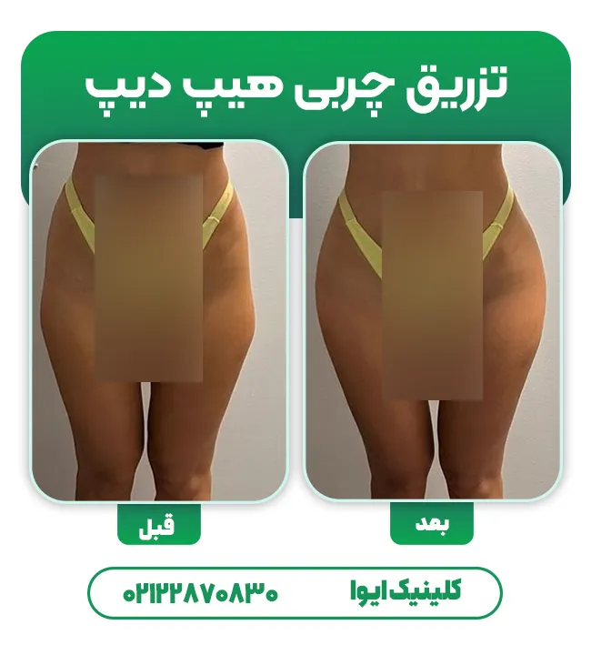 تزریق چربی هیپ دیپ