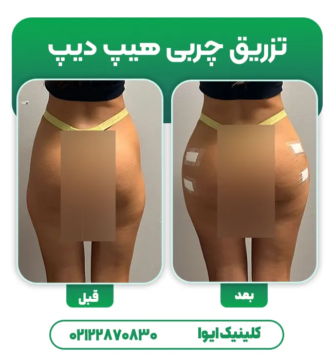 تزریق چربی هیپ دیپ