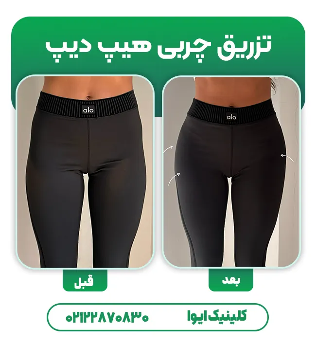 تزریق چربی هیپ دیپ