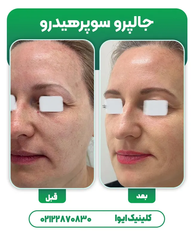 قبل و بعد تزریق جالپرو سوپرهیدرو