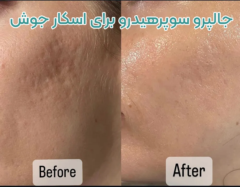 قبل و بعد تزریق جالپرو سوپرهیدرو