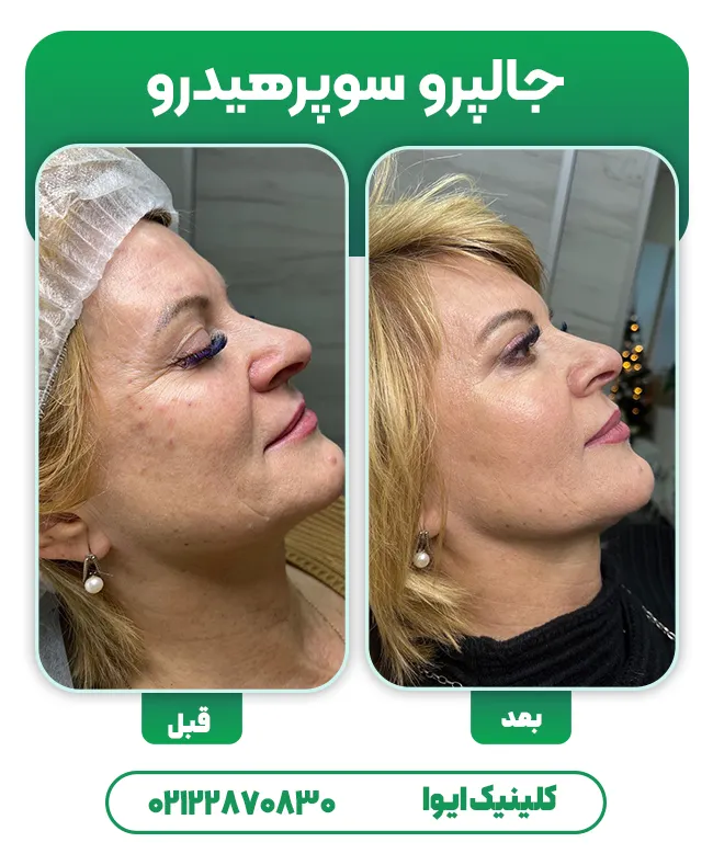 قبل و بعد تزریق جالپرو سوپرهیدرو