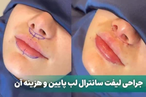 لیفت سانترال لب پایین