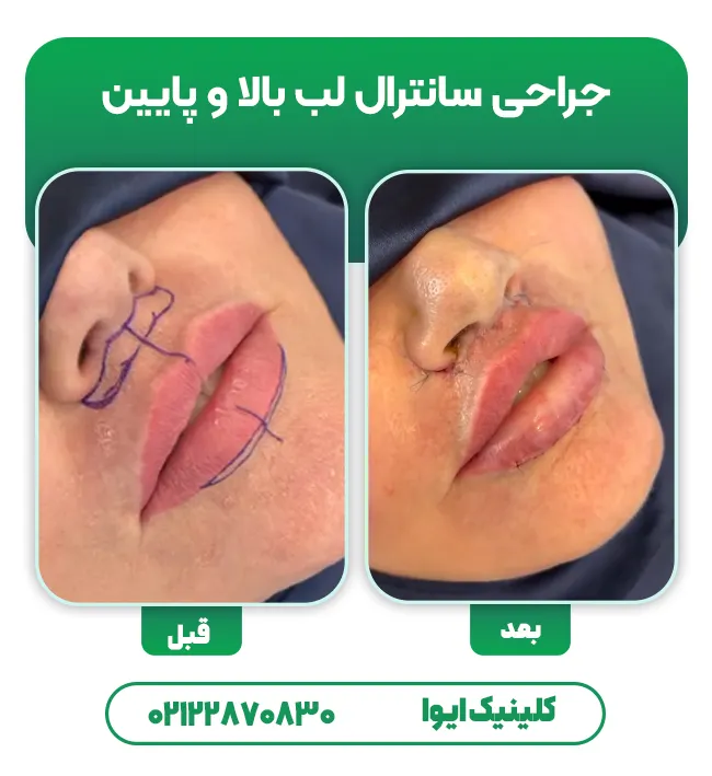 جراحی سانترال لب پایین