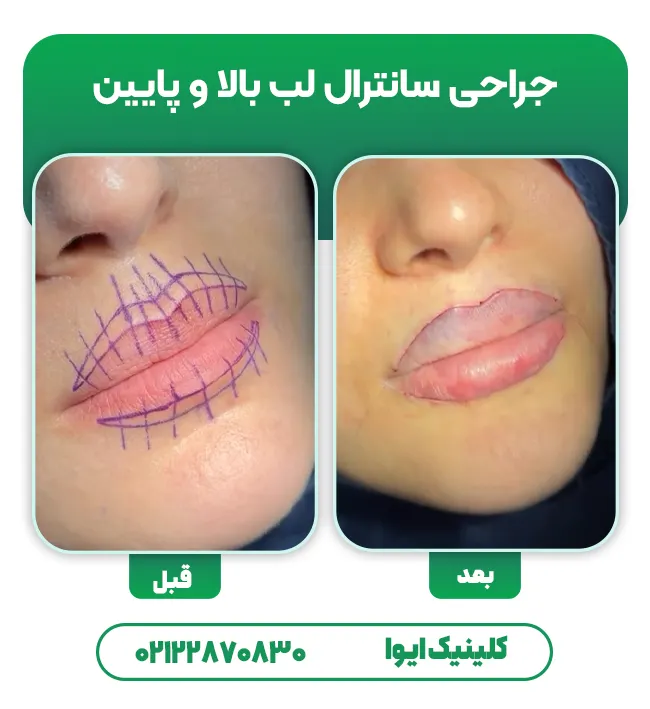 جراحی سانترال لب بالا و پایین
