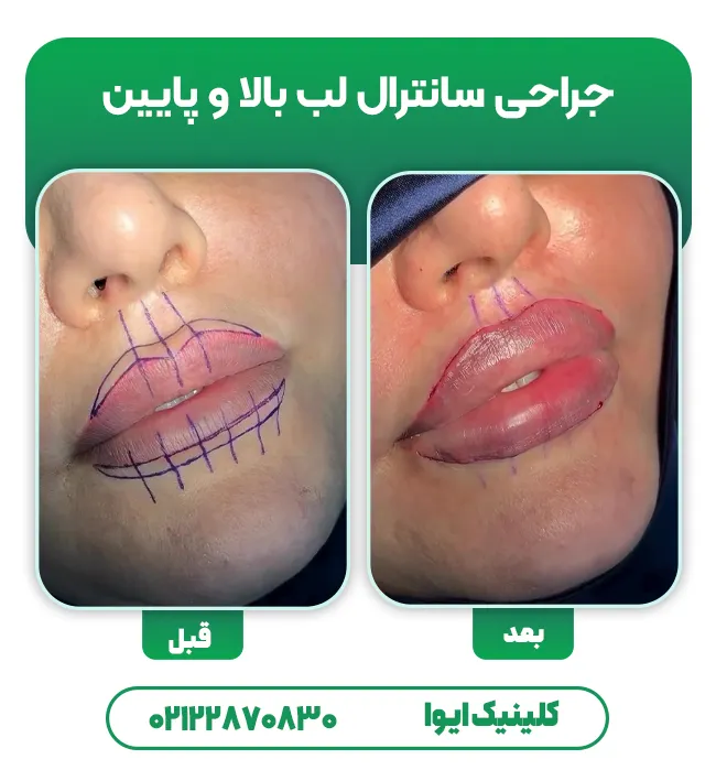 جراحی سانترال لب پایین و بالا