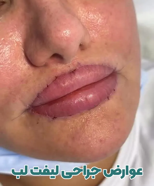 عوارض عمل لیفت لب پایین