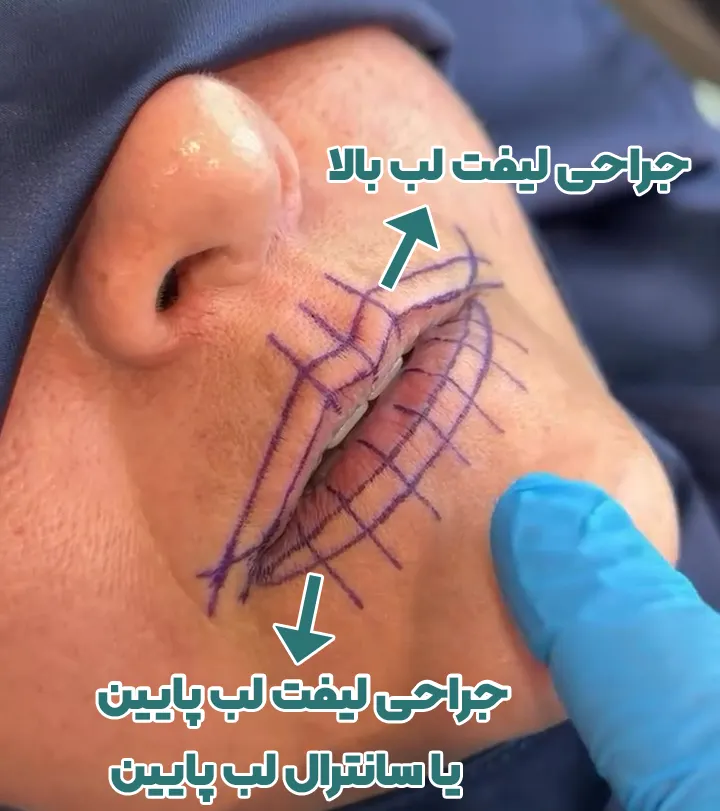 جراحی لیفت لب بالا و پایین