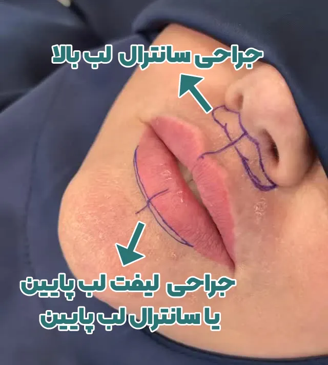 تفاوت جراحی لیفت بالا و پایین