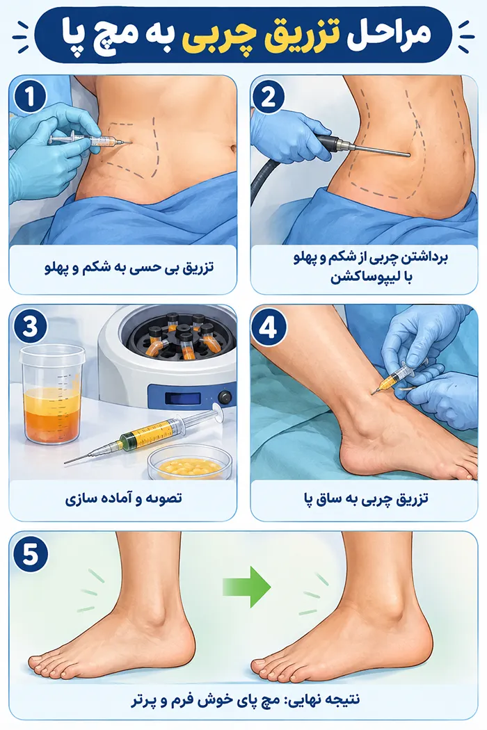 مراحل تزریق چربی به مچ پا