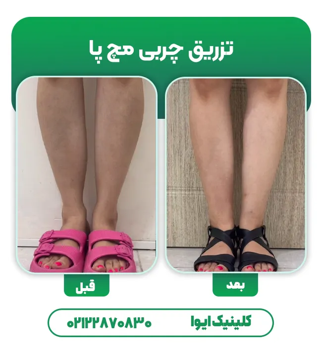 تزریق چربی به مچ پا