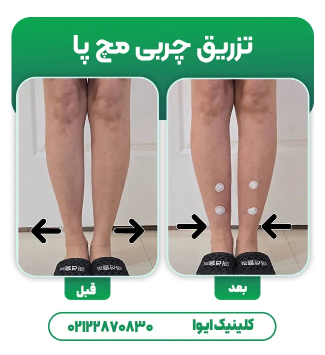 تزریق چربی به مچ پا