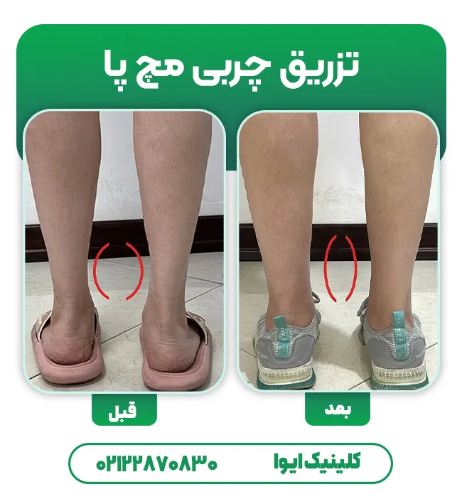 تزریق چربی به مچ پا
