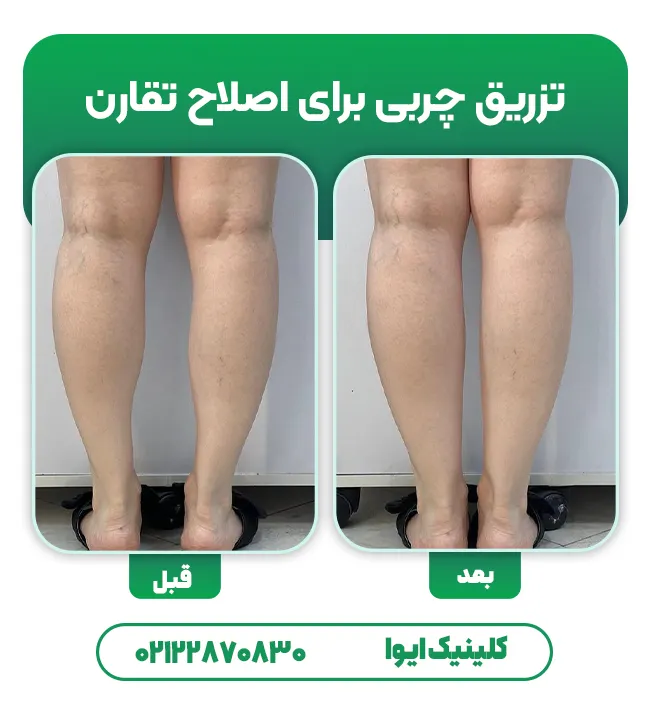 تزریق چربی به مچ پا