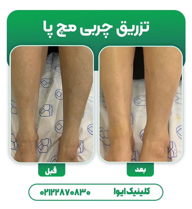 تزریق چربی به مچ پا