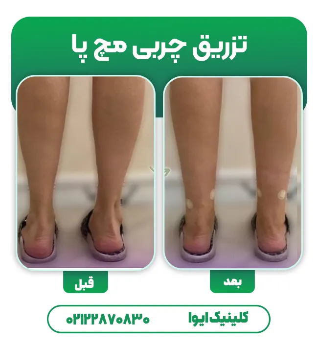 تزریق چربی به مچ پا