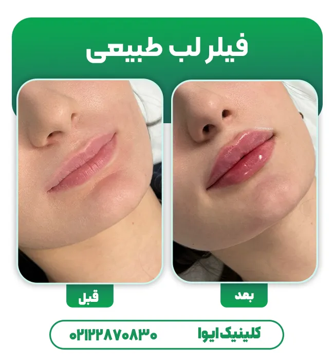 فیلر لب طبیعی
