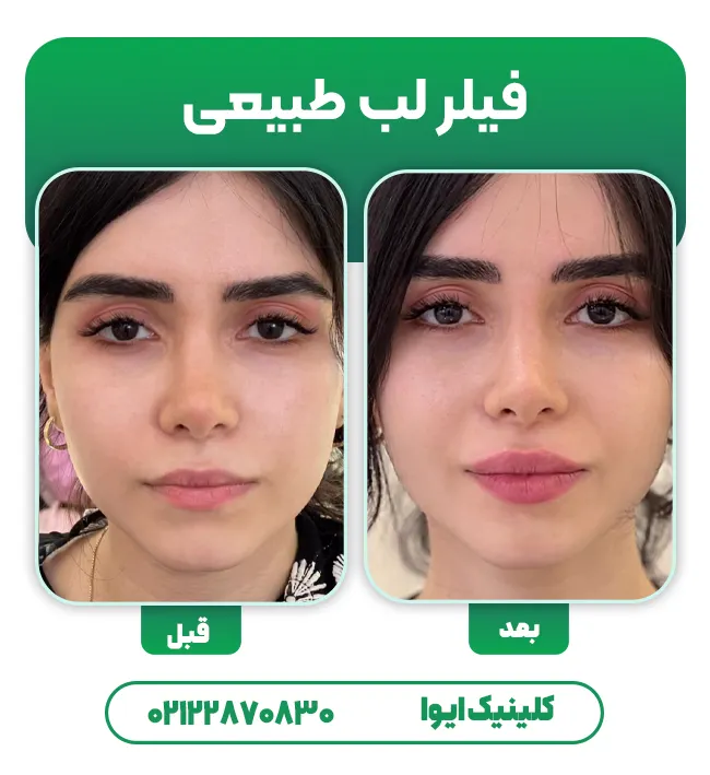 فیلر لب طبیعی
