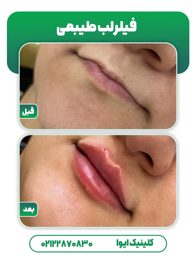 فیلر لب طبیعی
