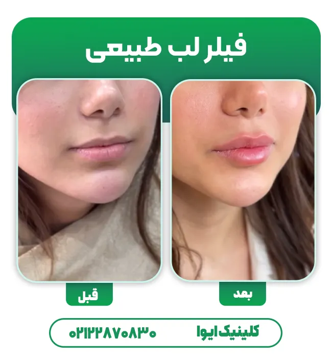 فیلر لب طبیعی