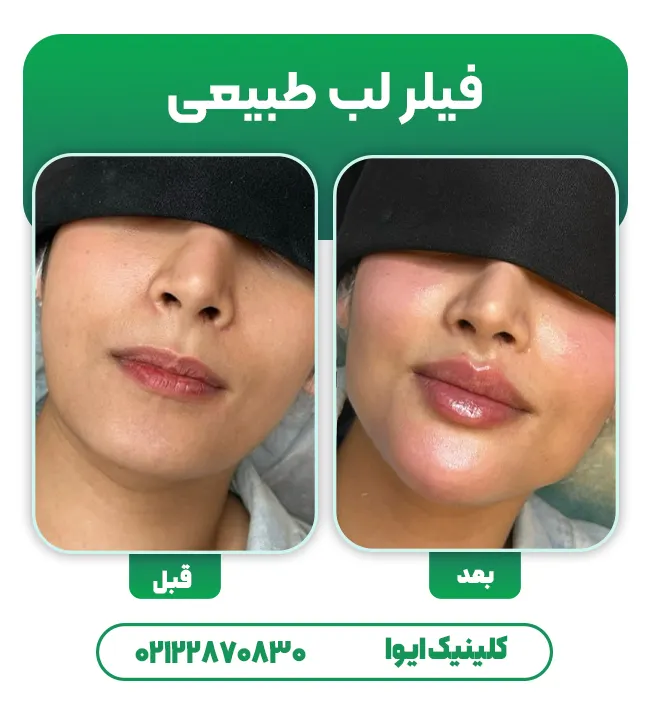 فیلر لب طبیعی