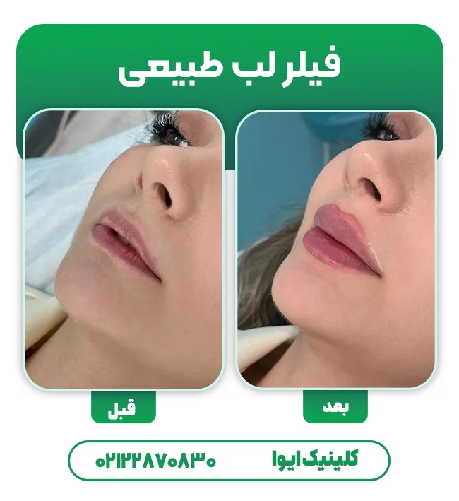 فیلر لب طبیعی