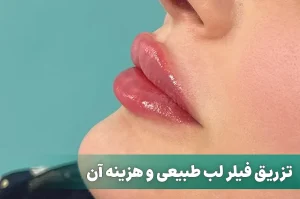 فیلر لب طبیعی
