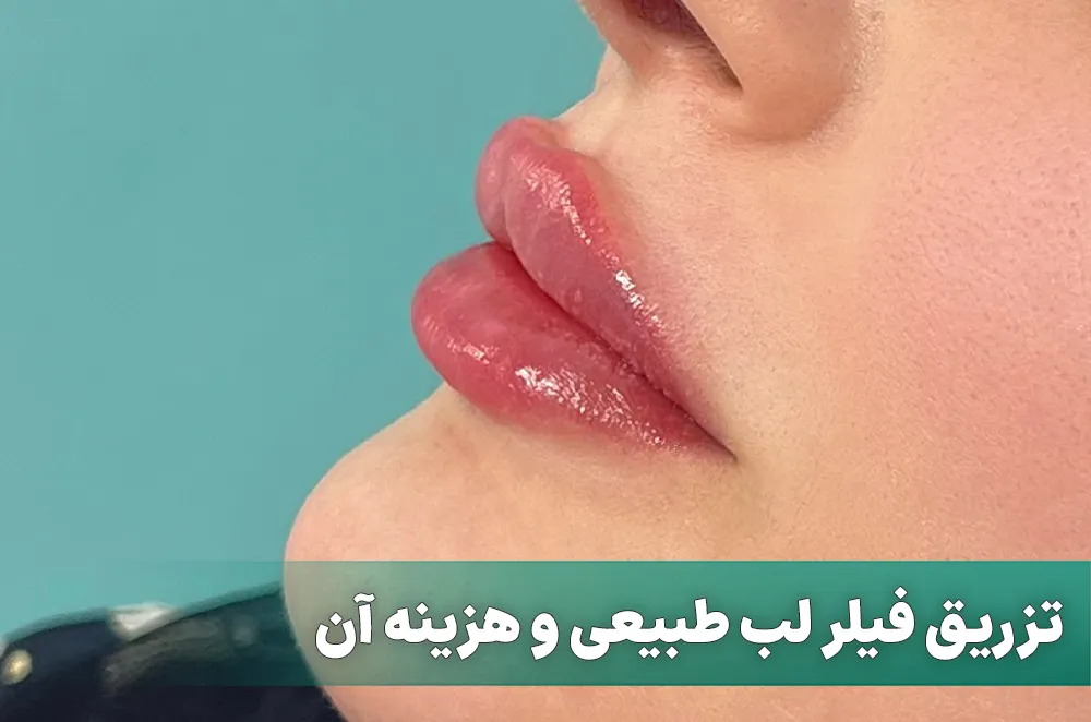 فیلر لب طبیعی