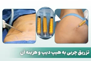 تزریق چربی به هیپ دیپ