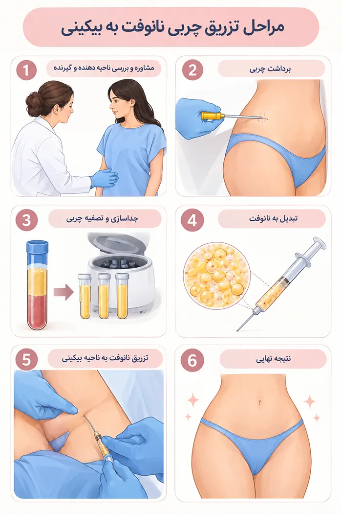 مراحل تزریق چربی بیکینی