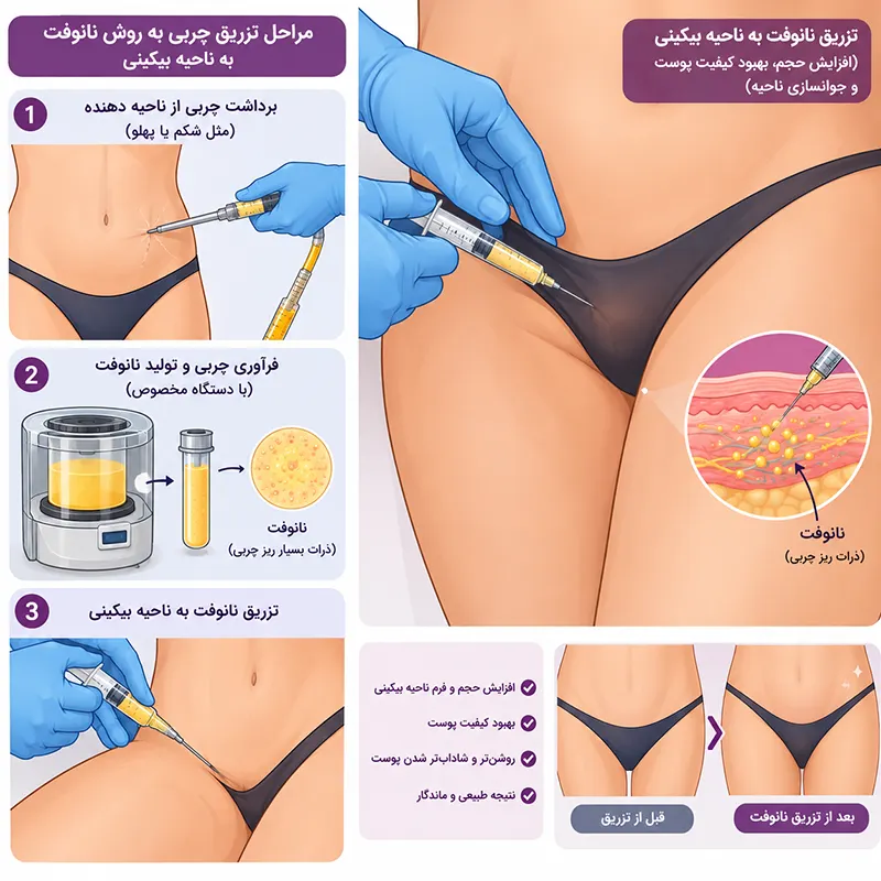 تزریق چربی به بیکینی به روش نانوفت