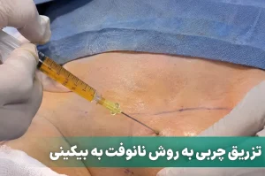 تزریق چربی به بیکینی به روش نانوفت
