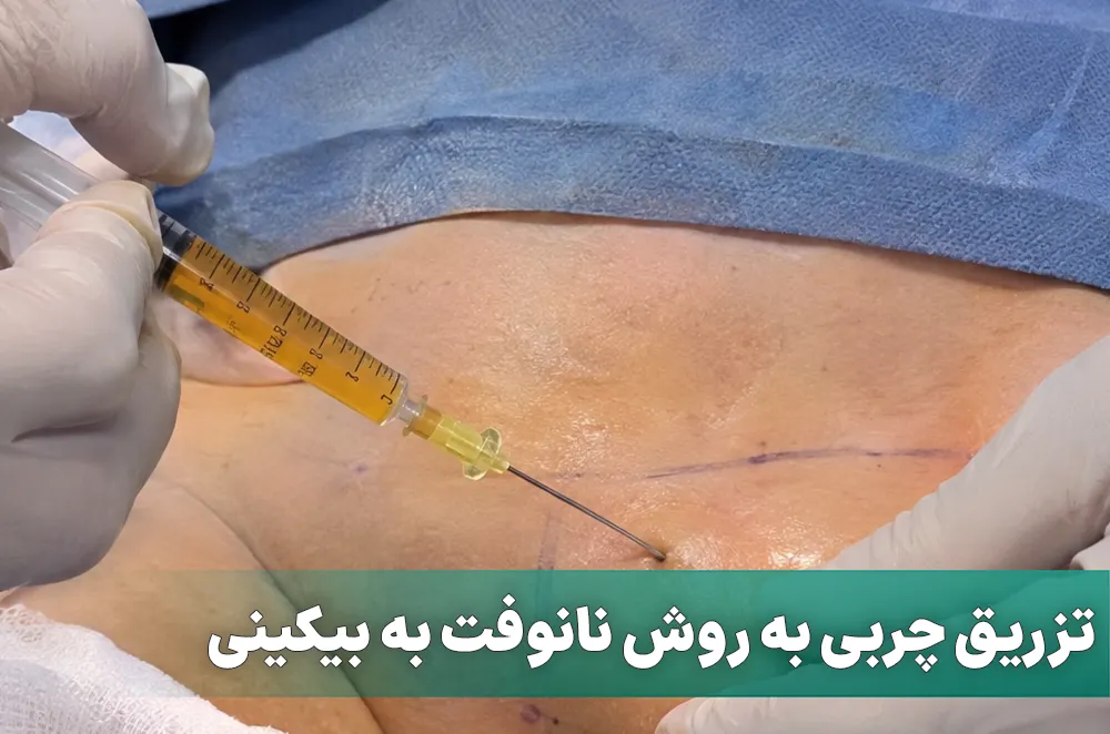 تزریق چربی به بیکینی به روش نانوفت